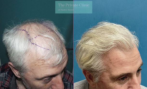 FUE Hair Transplant - 042MM - side