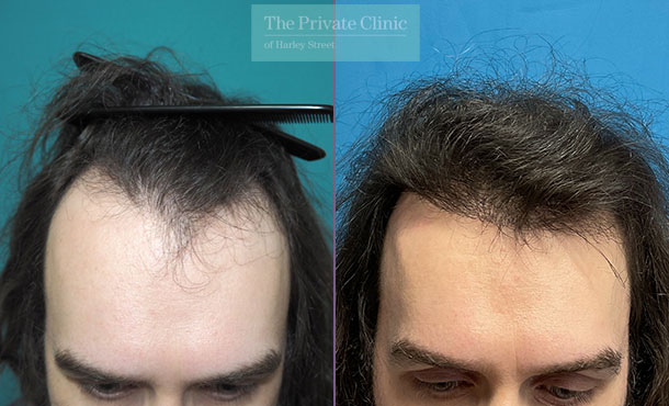 FUE Hair Transplant - 041MM - FRONT