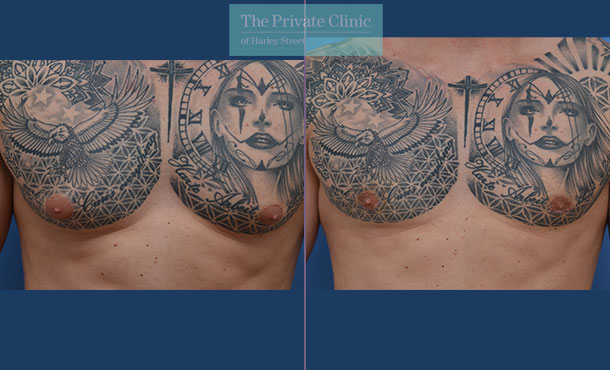 male breast reduction before after photo