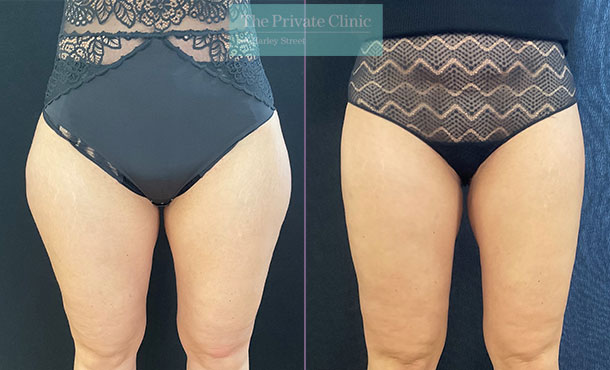 micro lipo outer thighs before and after photos