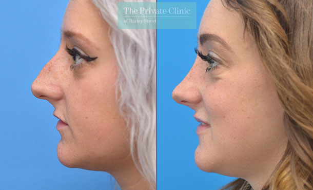 rhinoplasty uk before and after photos