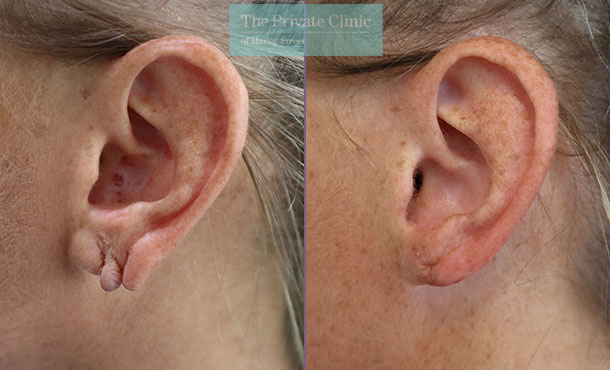 before and after results of split earlobe repair