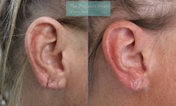 before and after results of split earlobe repair