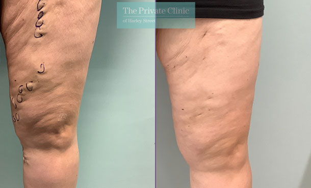 Varicose Vein - 004TH - front