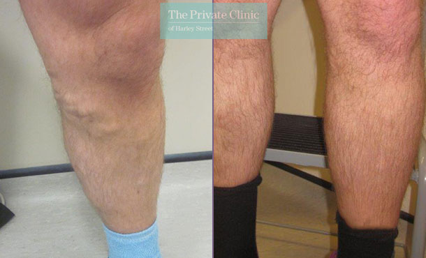 varicose vein removal before and after photo results