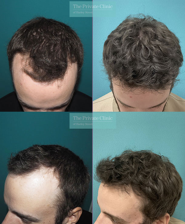 hair transplant results temple and hairline restoration