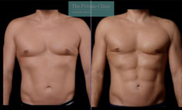 vaser hi def liposuction before after results male chest