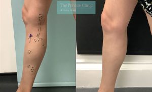 Varicose Veins Leg procedure before and after photos