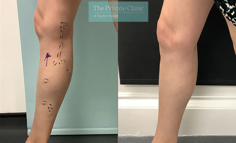 Varicose Veins in Pregnancy - Liverpool Varicose Veins Clinic