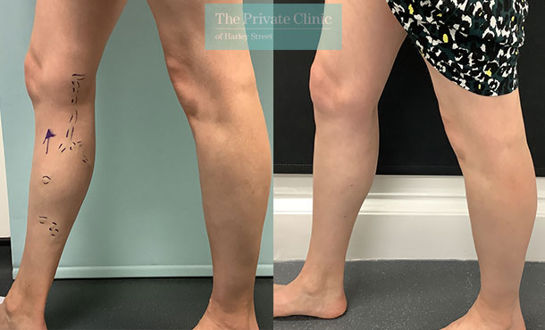 . Varicose Veins Leg procedure before and after photos