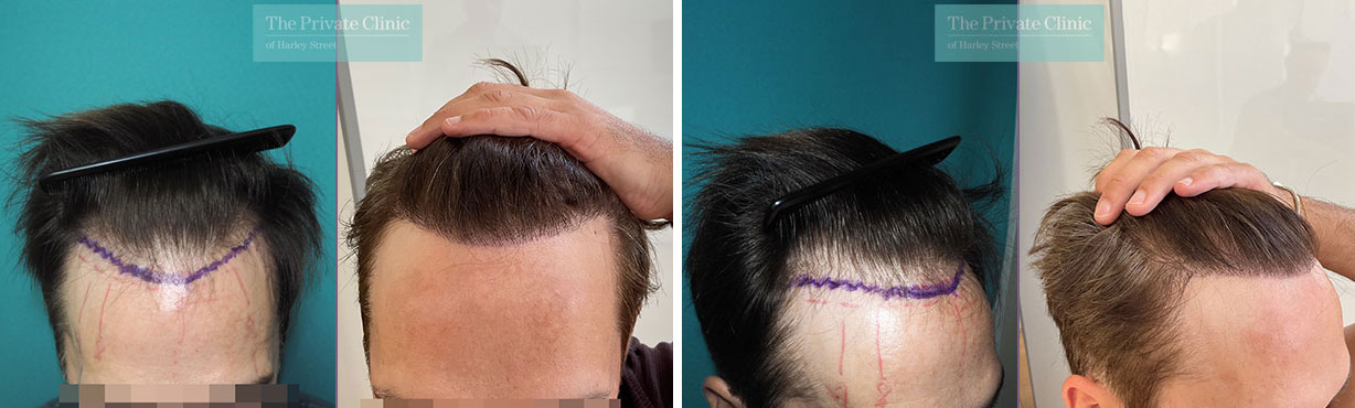 1000 graft Hair Transplant Repair Cases - Before and After! - YouTube