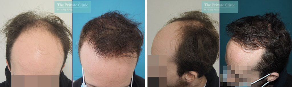 3000 hair grafts FUE Hair Transplant before and after result photos