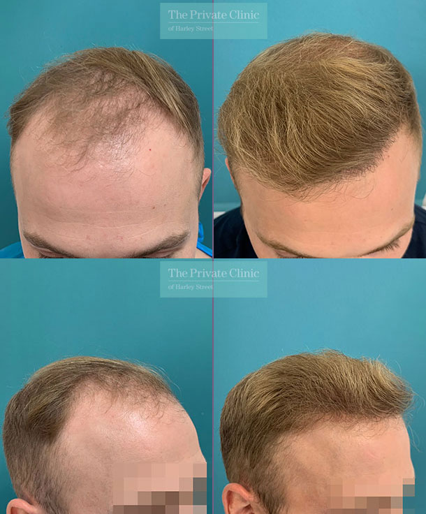 FUE Hair Transplant before after result, best surgical result finalist 2023