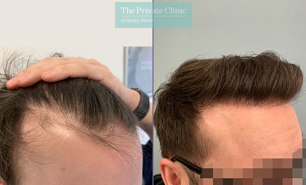 fue hair transplant before after photos results front temples