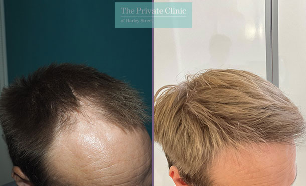 Hair Transplant - 045MM - side