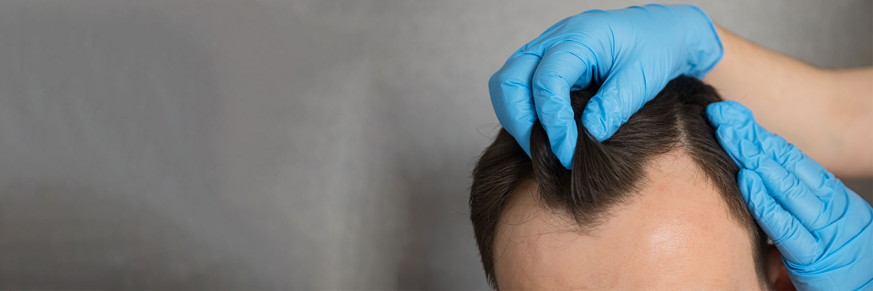 Hair transplant: how many hair grafts for Hair Coverage, 500 – 3000 hair  grafts