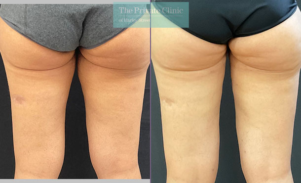 micro lipo to the inner thighs before after photo