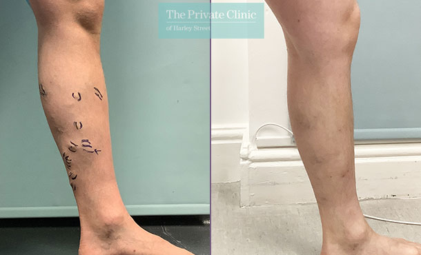 Varicose Veins - 002DP - Side