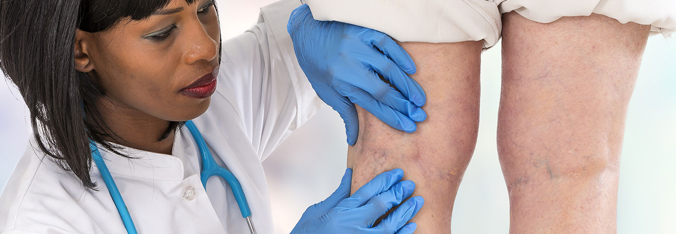 what-are-blue-veins-thread-veins-treatment