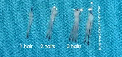 hair graft vs hair follicle, 1 graft = 1 - 4 hairs