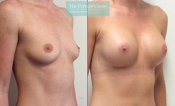 275cc breast implants enlargement high profile before after results