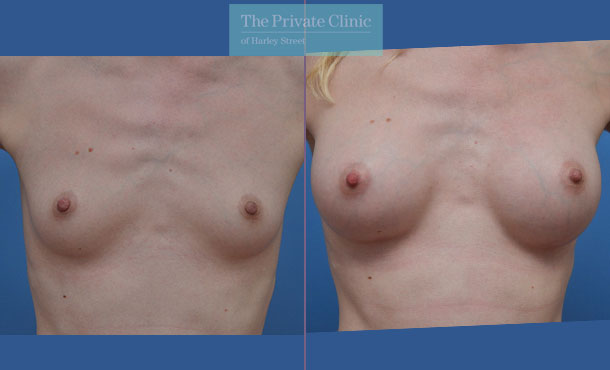 300cc breast implants before after photos moderate profile breast augmentation enlargement