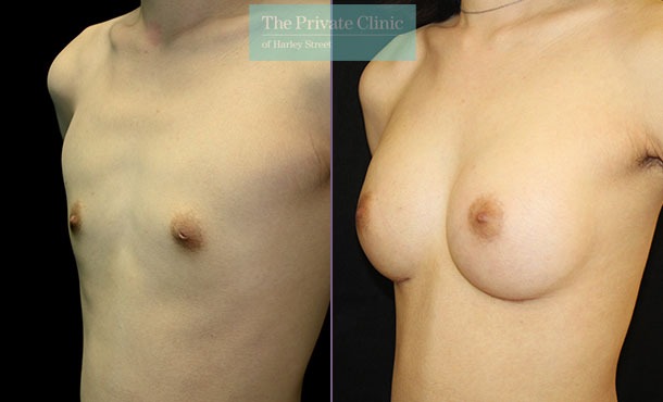 breast augmentation enlargement surgery 250cc breast implants under the muscle