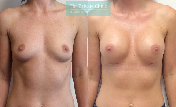 breast augmentation implants surgery before after photos 275cc breast implants
