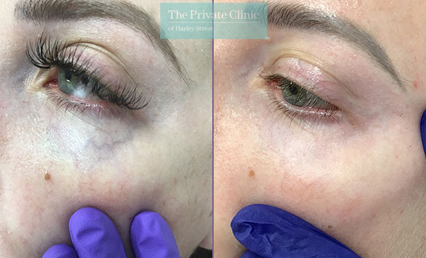 under-eye-veins-before-after-treatment-results
