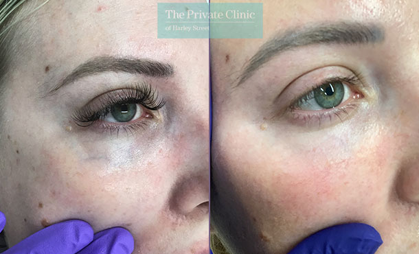 under-eye-veins-before-after-treatment-results