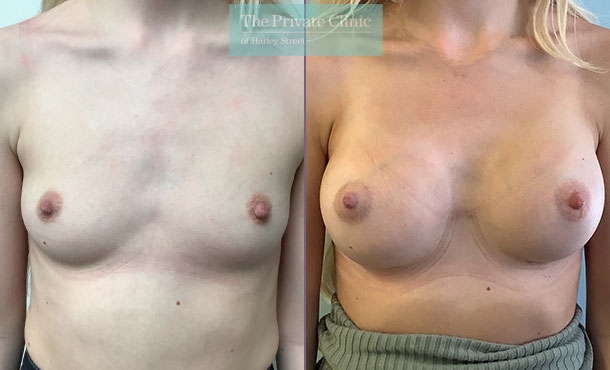 325cc breast implants enlargement surgery high profile dual plane augmentation results