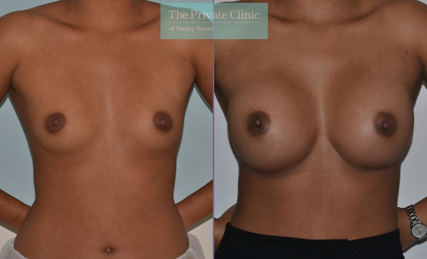360cc breast implants moderate profile under the muscle breast enlargement before after photos
