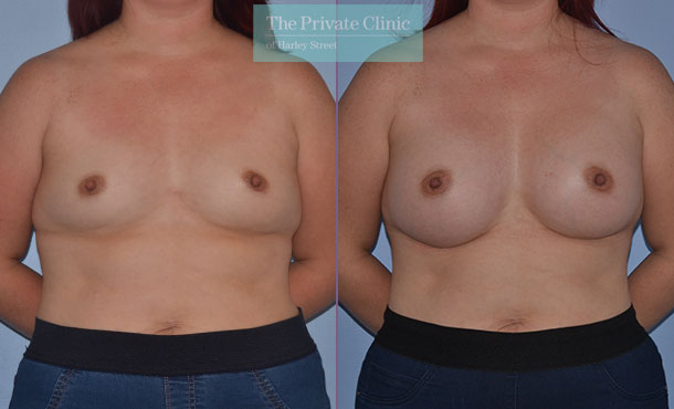 390cc breast implants moderate profile above the muscle breast enlargement result
