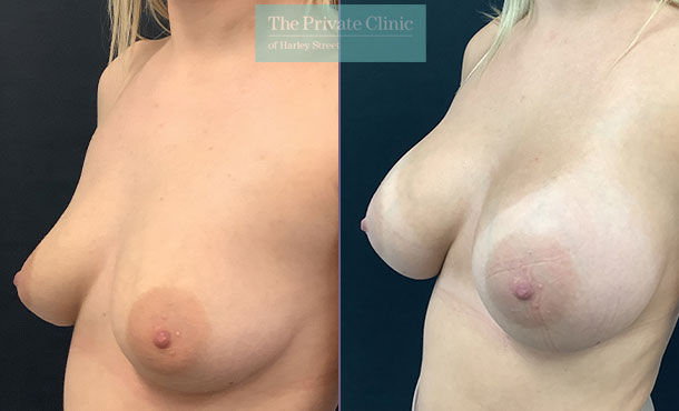 425cc breast implants high profile dual plane breast implants enlargement surgery