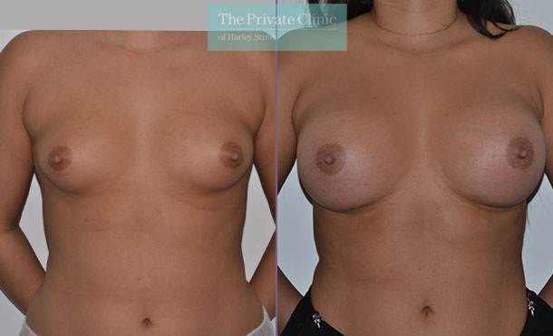 460cc high profile breast enlargement implants before after results
