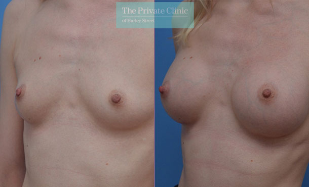 breast augmentation enlargement 300cc implants moderate profile