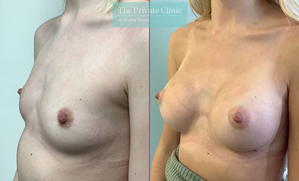 breast augmentation enlargement boob job 325cc breast implants surgery before after results
