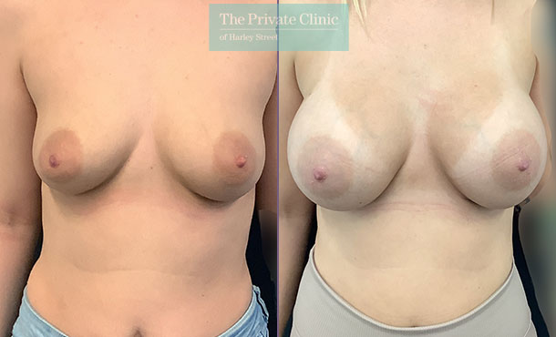 breast augmentation enlargement boob job before after results 425cc breast-implants