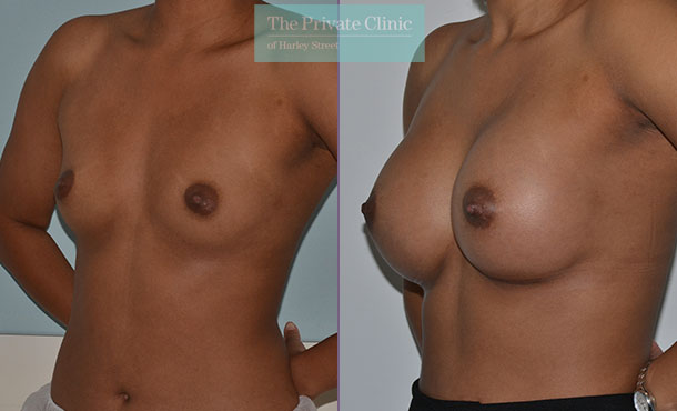 360cc breast implants moderate profile under the muscle breast enlargement before after photos