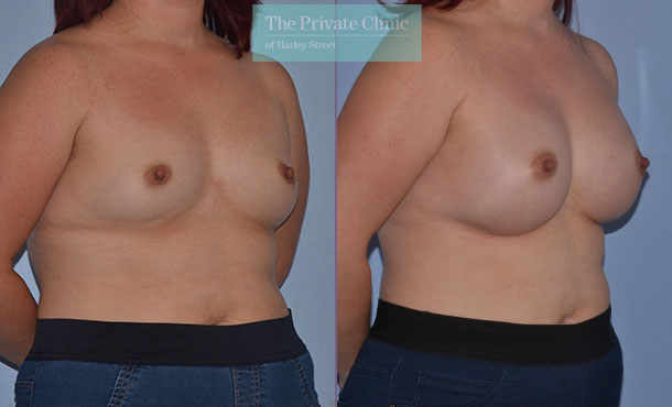 breast enlargement augmentation before after results 390cc implants