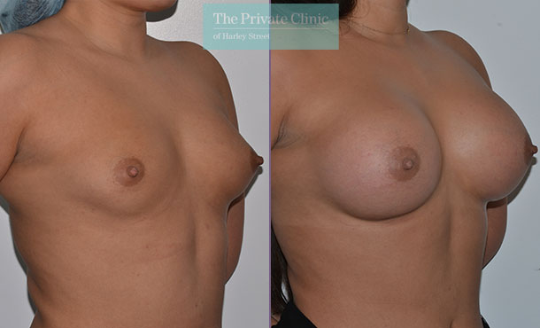 breast enlargement implants before after 460cc breast implants results