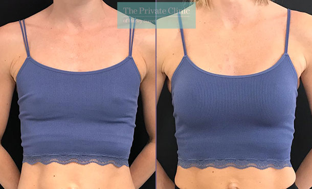breast enlargement before after results