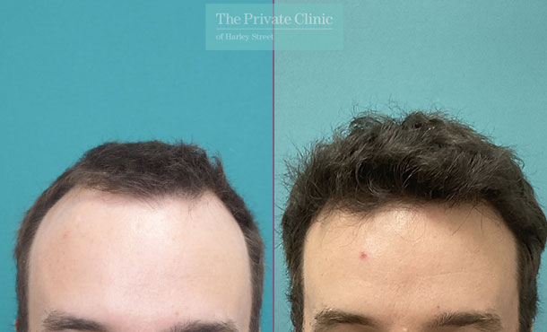 FUE Hair Transplant - 050MM front