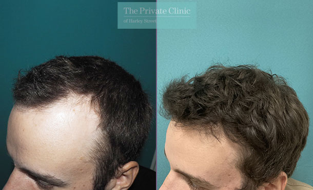 FUE Hair Transplant - 050MM side