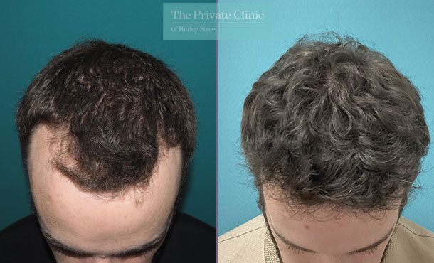 FUE Hair Transplant - 050MM top