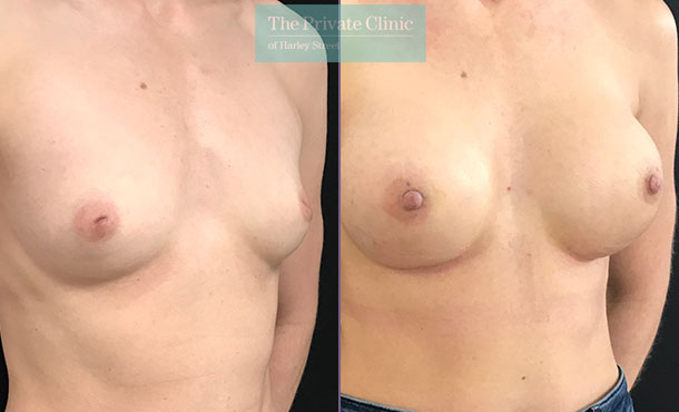 inverted nipple correction results