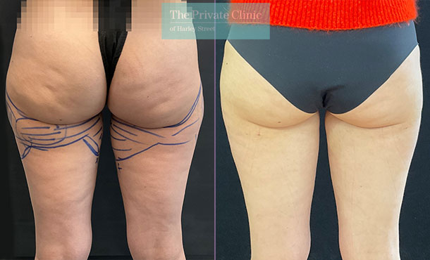 micro liposuction before and after results