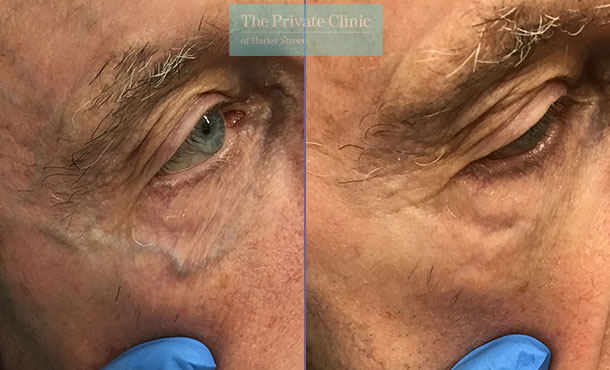 Under eye thread vein treatment before after results