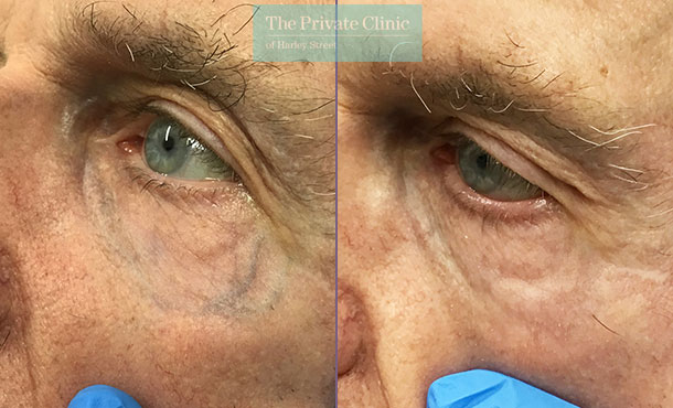 Under eye thread vein treatment before after results