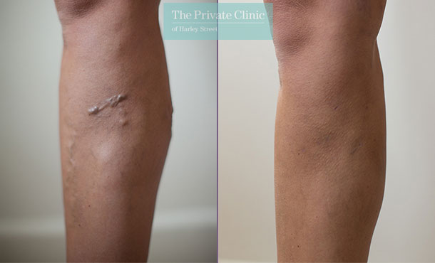 varicose veins removal surgery Northampton before after photos